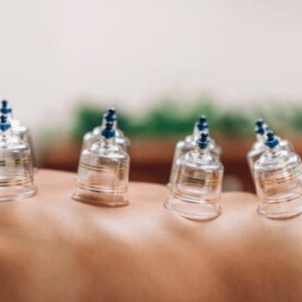 Schröpfgläser auf dem Rücken einer Person zur therapeutischen Anwendung